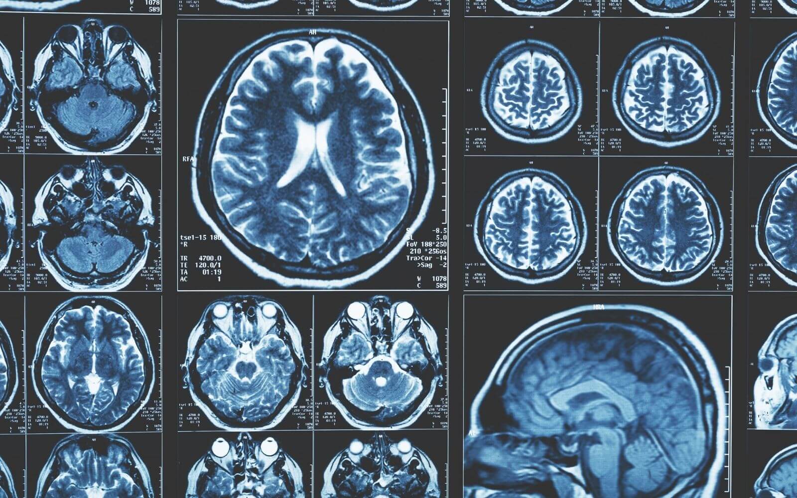 Recent Advances in Stem Cell Therapy of Stroke