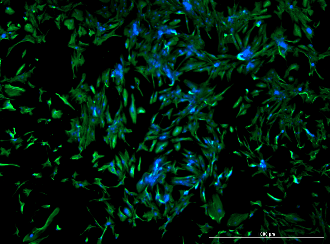 Human Renal Cell Carcinoma Cancer Associated Fibroblasts 1,000,000 Cell Per Vial